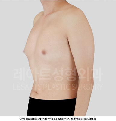 gynecomastia before and after