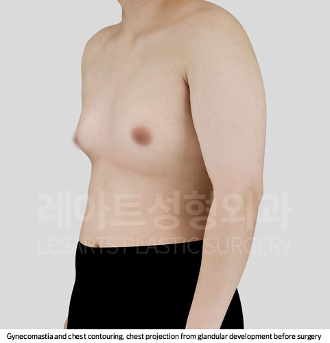 gynecomastia-02-01-251107