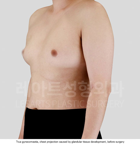 gynecomastia-02-01-251112