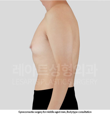 gynecomastia-02-02-251029