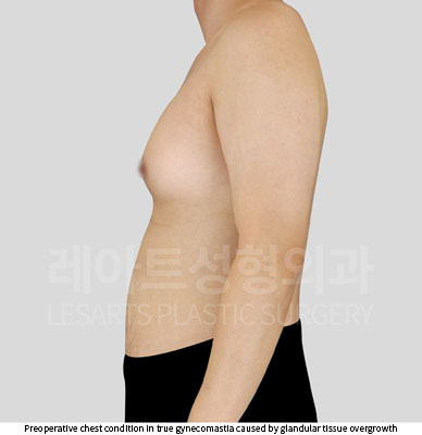 gynecomastia-02-02-251105