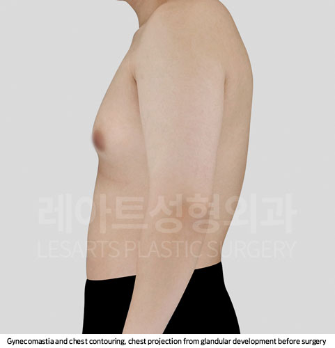 gynecomastia-02-02-251107