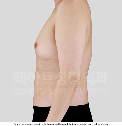 gynecomastia-02-02-251112
