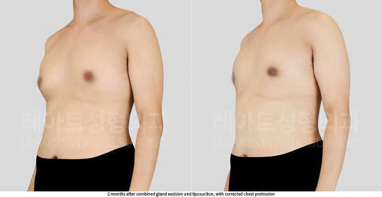gynecomastia-02-03-251105