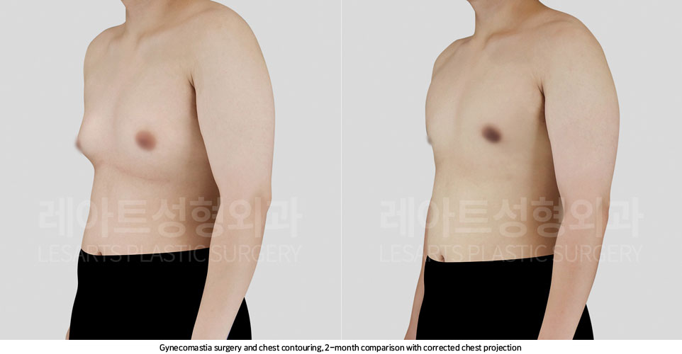 gynecomastia-02-03-251107