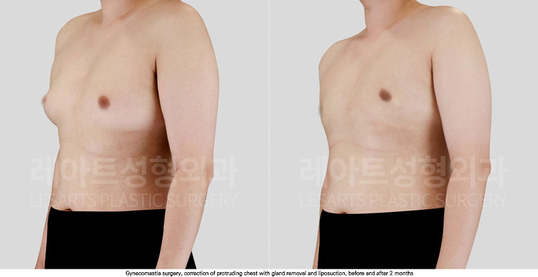 gynecomastia-02-03-251112