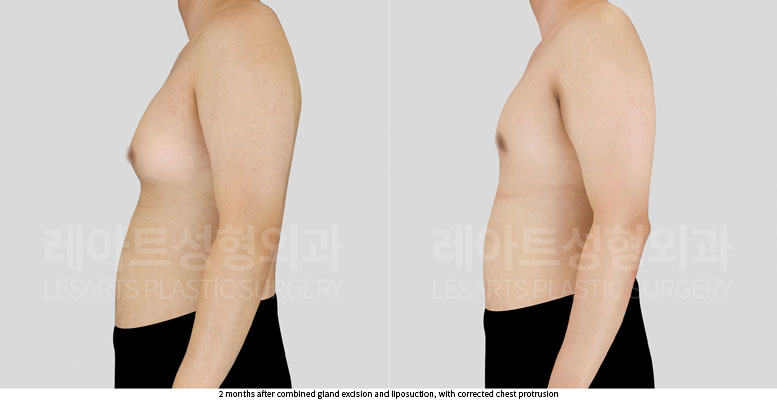gynecomastia-02-04-251105