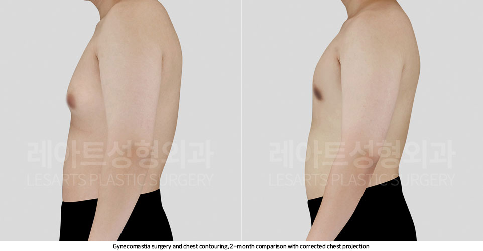 gynecomastia-02-04-251107