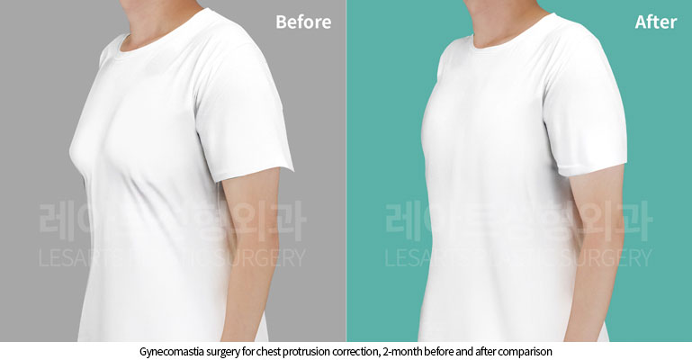 gynecomastia before and after(t-shirt)