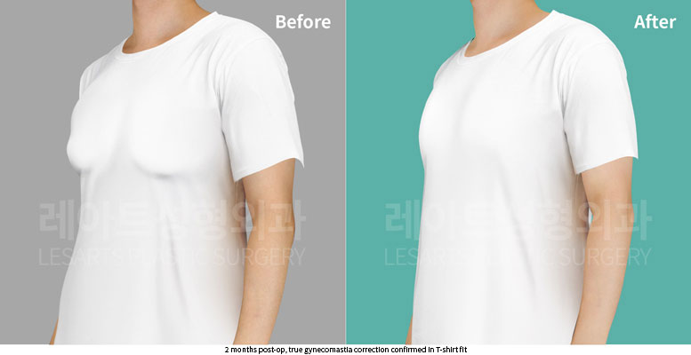 gynecomastia-02-05-251105