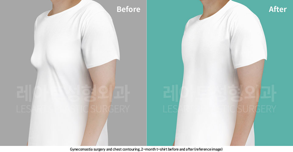 gynecomastia-02-05-251107