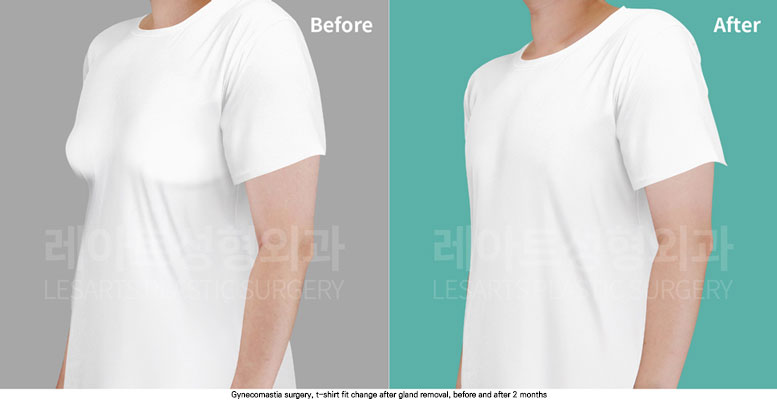 gynecomastia-02-05-251112