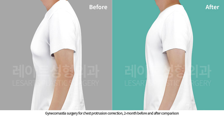 gynecomastia-02-06-251029