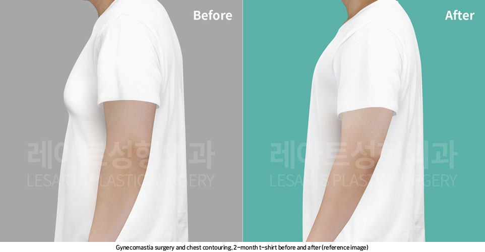 gynecomastia-02-06-251107