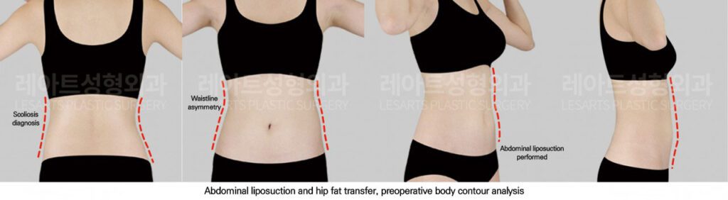 hip-dip-fat-transfer-02-01-251117