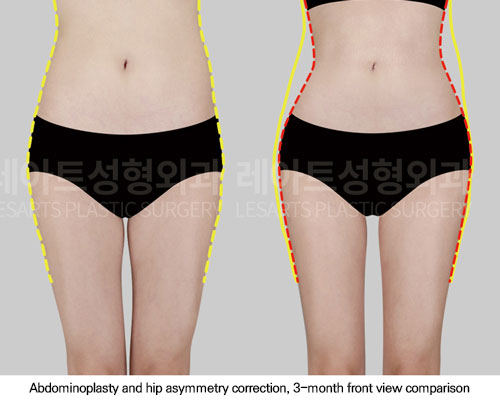 hip-dip-fat-transfer-02-03-251117