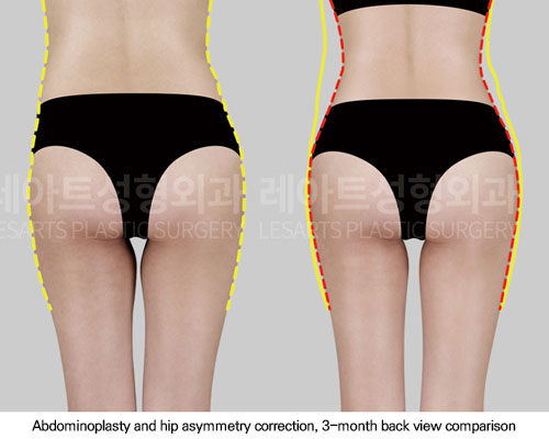 hip-dip-fat-transfer-02-04-251117