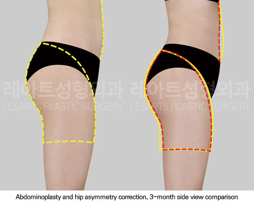 hip-dip-fat-transfer-02-05-251117