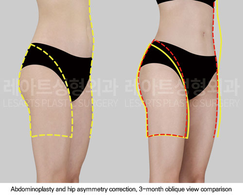 hip-dip-fat-transfer-02-06-251117