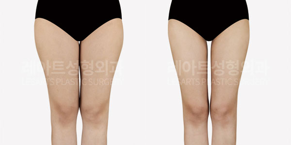 thigh liposuction before and after