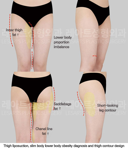 thigh-liposuction-02-01-251113