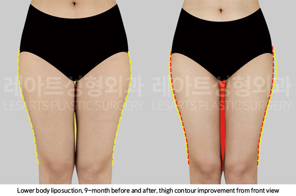 thigh-liposuction-02-02-251106