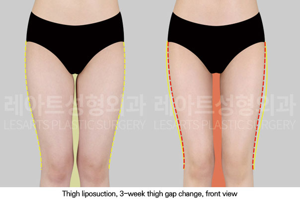 thigh-liposuction-02-02-251113