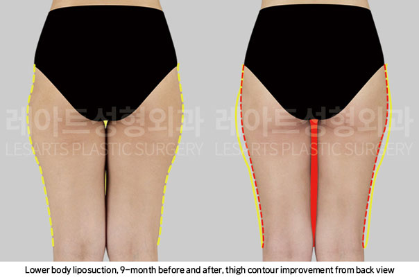 thigh-liposuction-02-03-251106