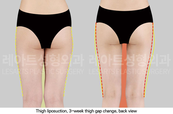 thigh-liposuction-02-03-251113