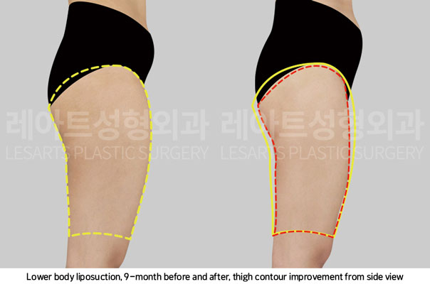 thigh-liposuction-02-04-251106