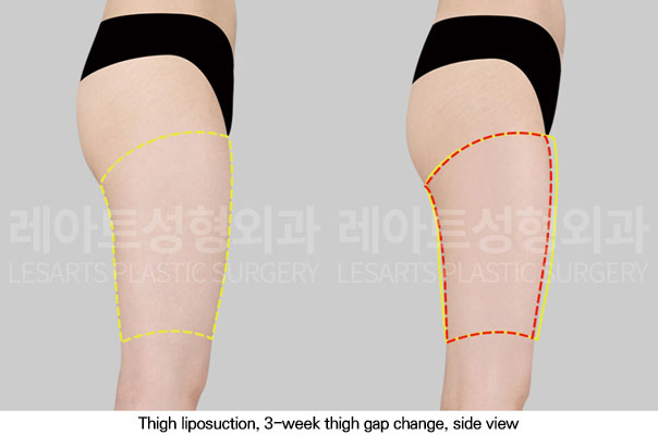 thigh-liposuction-02-04-251113