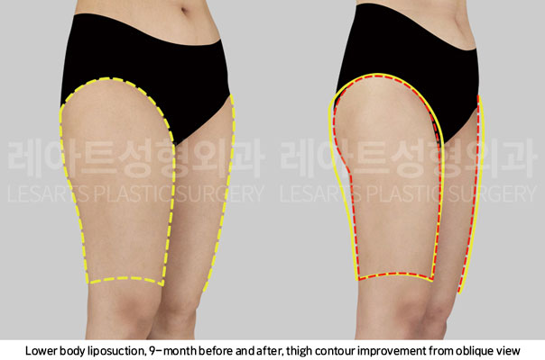 thigh-liposuction-02-05-251106