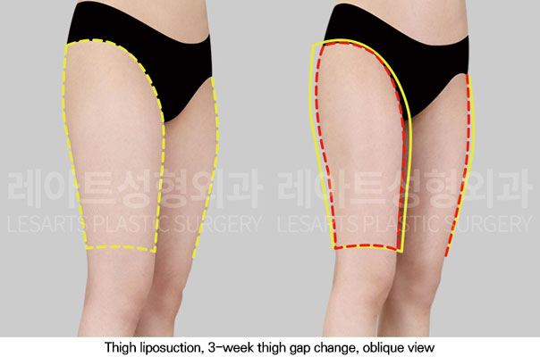 thigh-liposuction-02-05-251113