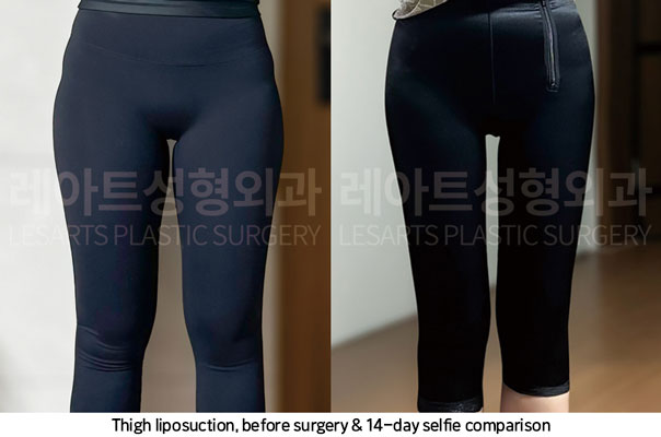 thigh-liposuction-02-06-251106