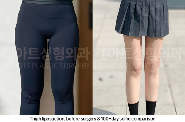 thigh-liposuction-02-07-251106
