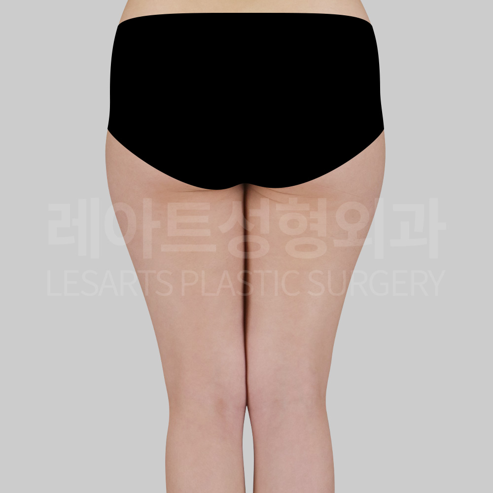 thigh-liposuction-29633-before-back