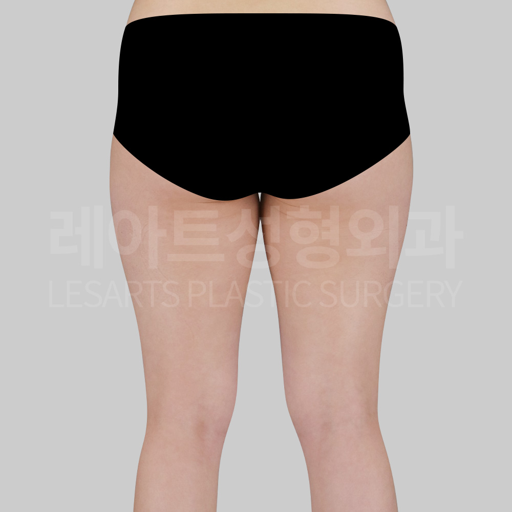 thigh-liposuction-29633-before-back2