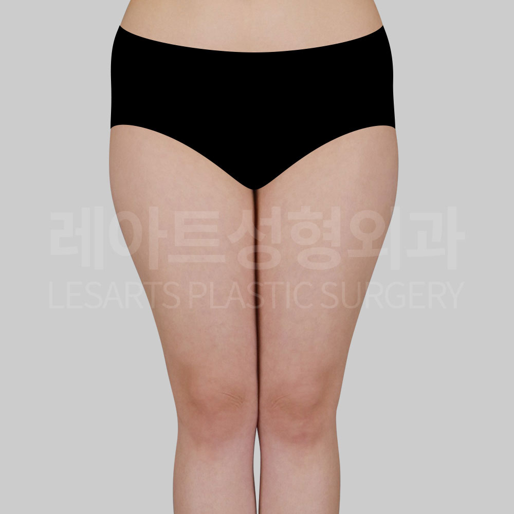 thigh-liposuction-29633-before-front