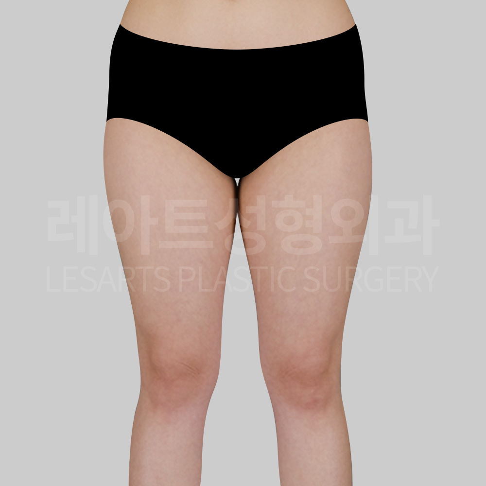 thigh-liposuction-29633-before-front2
