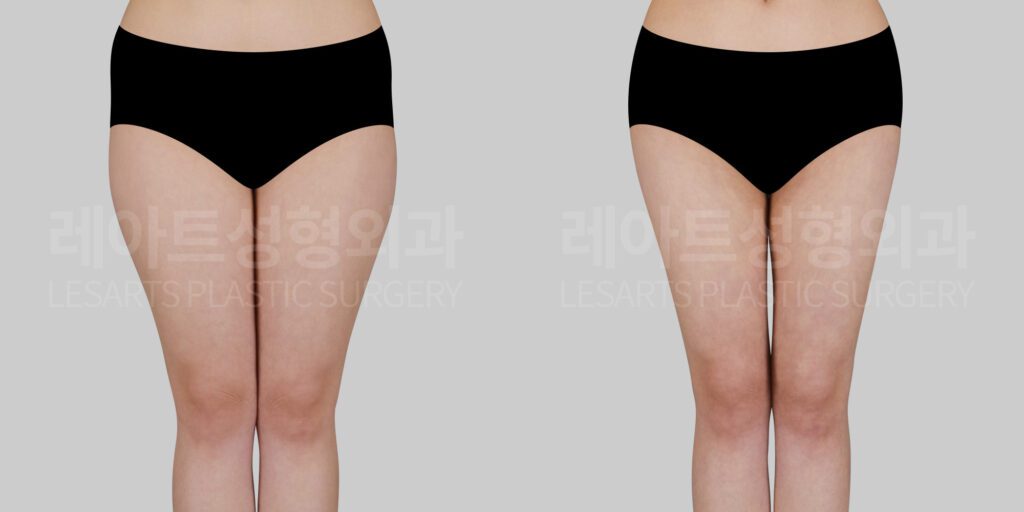 thigh liposuction before and after