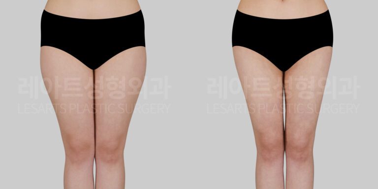thigh liposuction before and after