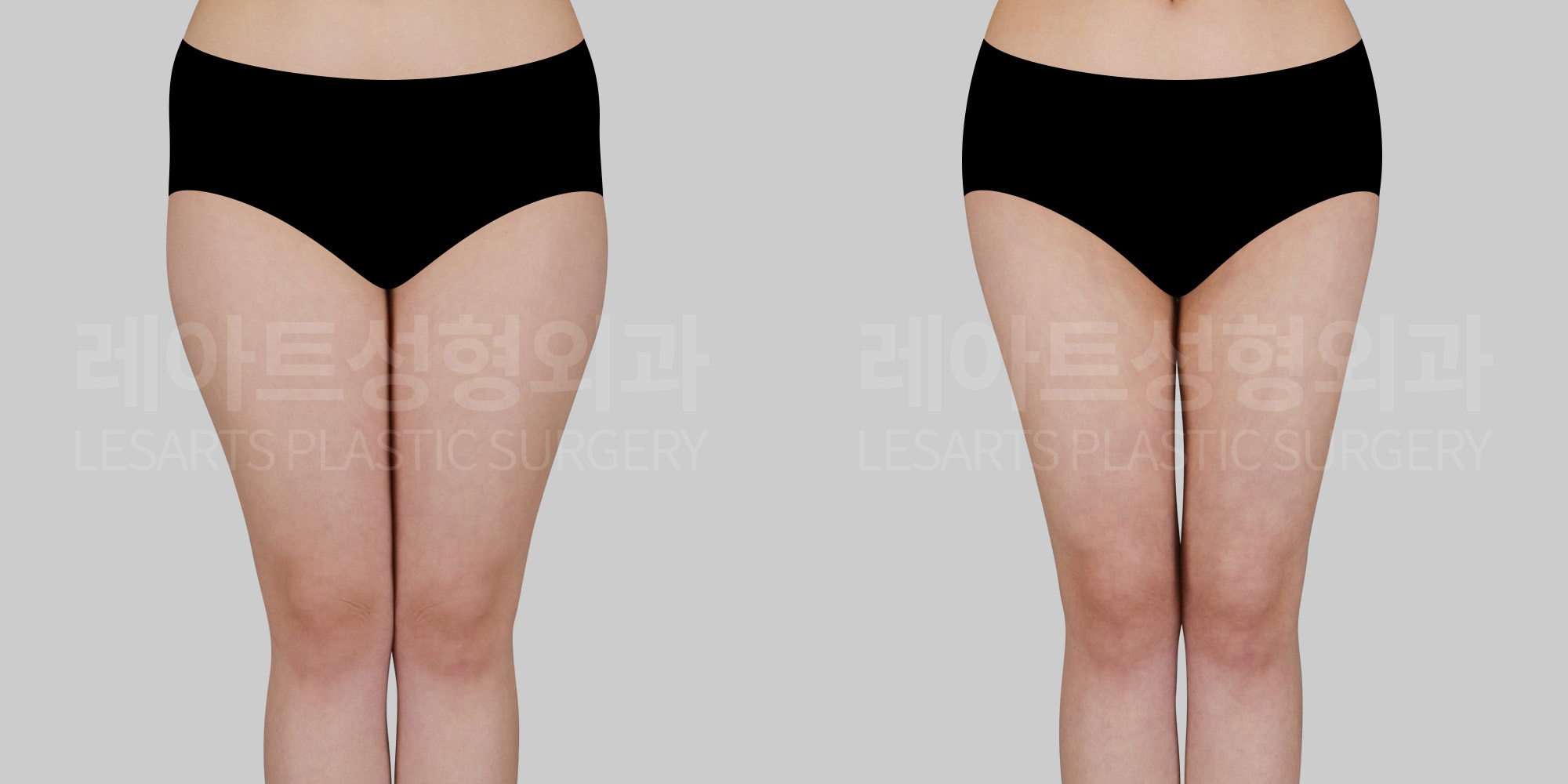 thigh liposuction before and after