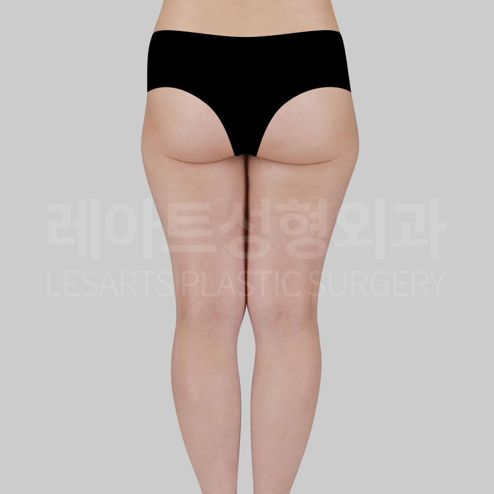 thigh-liposuction-29866-before-back
