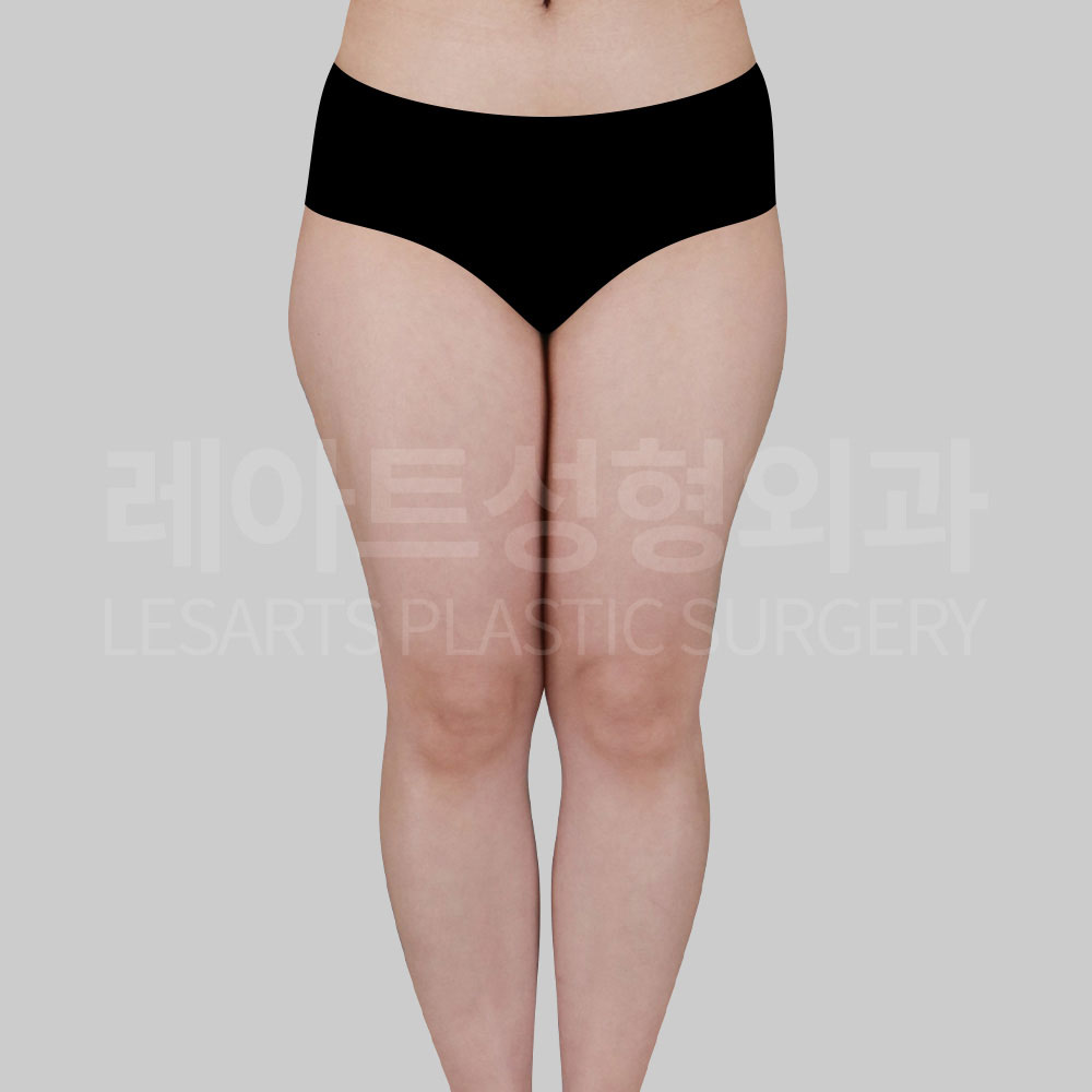 thigh-liposuction-29866-before-front