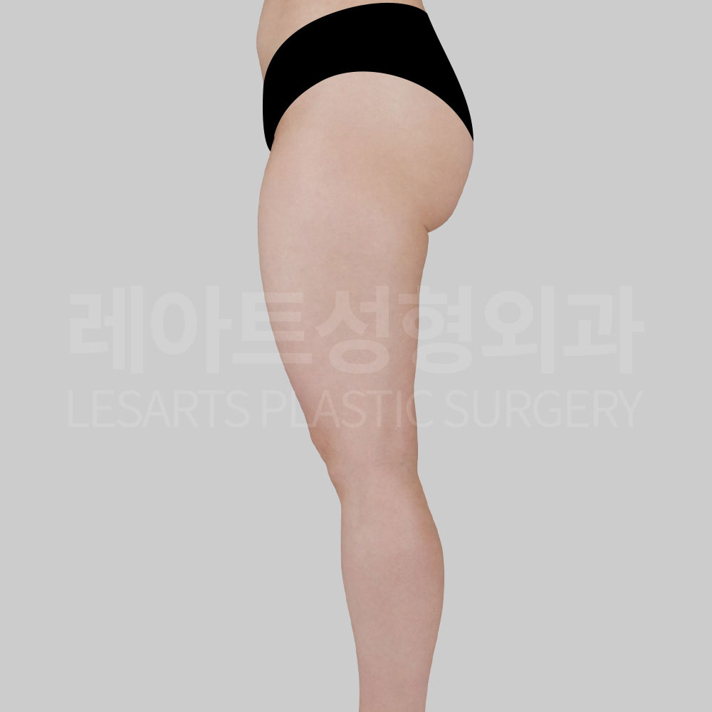 thigh-liposuction-29866-before-side