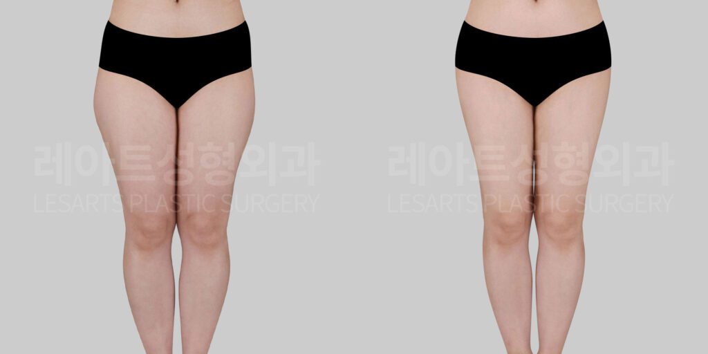 thigh-liposuction-before-and-after-29866