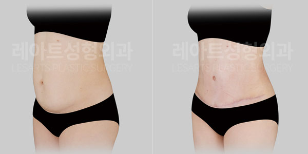 tummy tuck before and after(251016) - Lesarts