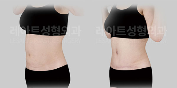 lesarts tummy tuck before and after