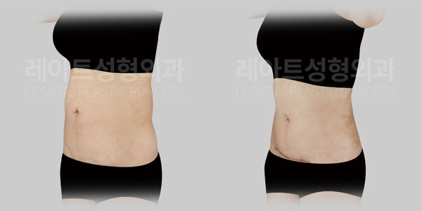lesarts tummy tuck before and after