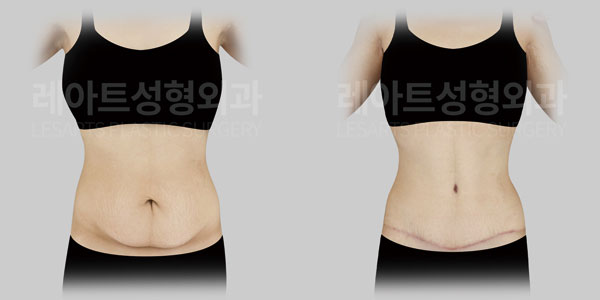 tummy tuck before and after - lesarts plastic surgery